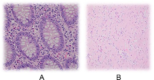 Mucosa of appendix can be seen with a mild eosinophilic infiltrate of the lamina propria and rare intraepithelial eosinophils. B Scattered eosinophils throughout the muscularis propria.