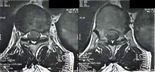 Preoperative MRI, axial view, T2WI, shows of hypointensely calcified regions within the tumor.