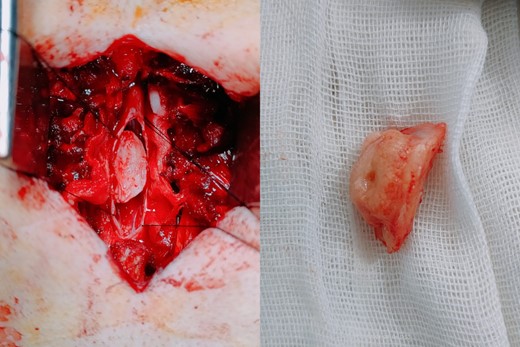 Intraoperative images showing the tumor after dissection and after complete excision.