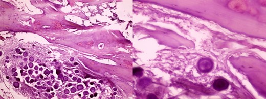 Histopathology shows the classical psammoma bodies, which are composed of calcium deposits or punctate calcifications within the tumor mass.