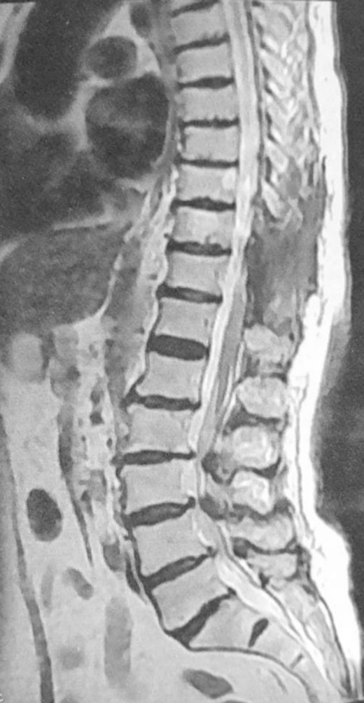 Postoperative MRI, sagittal view, T2WI, showing complete resection of the tumor.