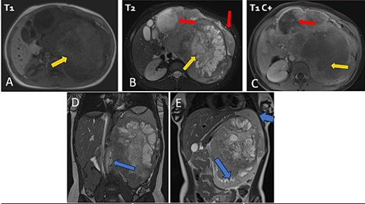 Abdominal MRI in axial T1 (A), T2 (B), and a T1 fat-saturated post contrast (Gadolinium) sequence (C), coronal T2 (D and E) showing a large retroperitoneal tumour process lateralized to the left, hypointense on T1-weighted, hyperintense, and heterogenous on T2-weighted images with central areas of necrosis and contrast-enhancing after Gadolinium administration. Lymph nodes and peritoneal carcinomatosis nodules are associated. Displacement of the vascular axes (D) and of the spleen of the left kidney responsible for left pelvicalyceal dilation (E).
