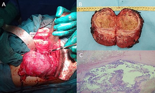Intraoperative image showing the kidney and the tumour lesion (A) and the gross specimen of a nephroureterectomy (B) with histologic staining showing post-therapeutic changes of the tumour, consisting of fibrosis, necrosis, and inflammation (C; H-E stain; original magnification, ×200).