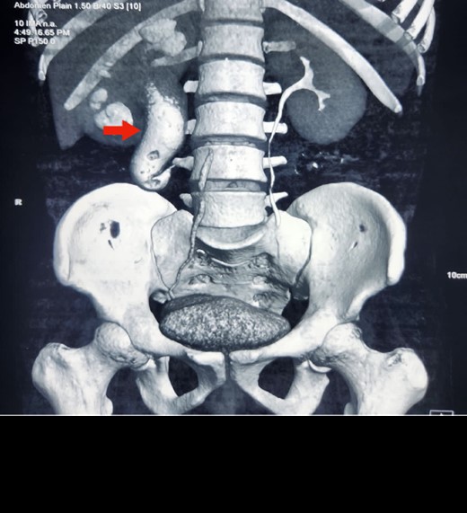 Reconstruction image of CECT KUB showing retrocaval ureter (arrow) and hydronephrosis of right kidney with dilated proximal ureter.