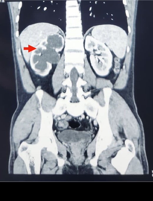 CECT KUB image showing gross right hydronephrosis (arrow).