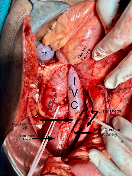 Intraoperative image showing the course of the retrocaval ureter and the important structures around it.