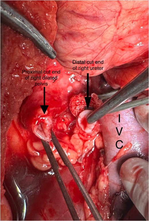 Intraoperative image showing cut end of the ureter.