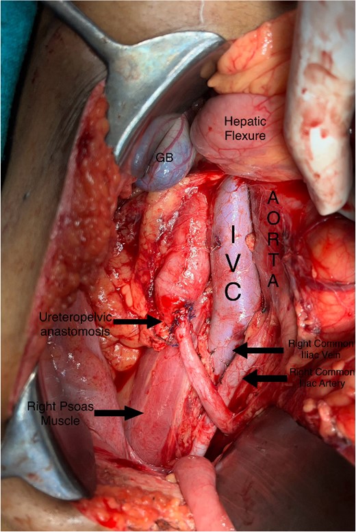 Intraoperative image showing pelviureteric anastomosis after resection of retrocaval part of the ureteric segment.
