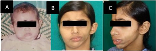 (A) Patient at 6 months of age without any deformity. (B, C) At presentation front and left oblique facial profile.