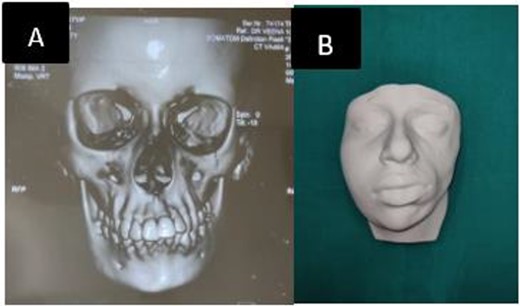 (A) Preoperative CT showing shortened left hemimandible. (B) 3 D model.