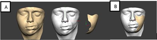 (A) Laser scanning for defect assessment. (B) Template.