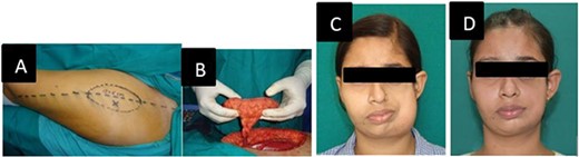 (A) Free anterolateral thigh flap preoperative marking. (B) Flap after harvest and ready for transfer. (C) After free ALT flap. (D) After flap debulking surgery.