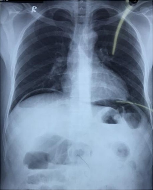 Erect chest X-ray showing free air under the diaphragm.