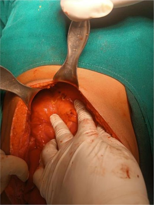 Falciform ligament used as a graft to repair the perforation site using polyglactin 3-0 sutures.