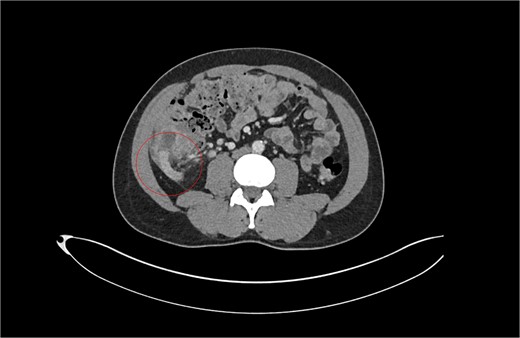 Patient A. Appendiceal stump of Patient A identified within the red circle on CT scan before the second operation.