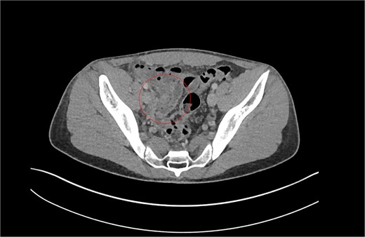 Patient B. Appendiceal stump of Patient B identified within the red circle on CT scan before the second operation.