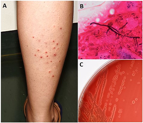 (A) Papulo-pustular skin lesions distributed on the right leg. (B) Gram-positive branching filaments with septations and coccoid cells. (C) Beta-haemolytic colonies isolated in culture on blood agar.
