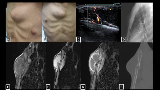 (A and B) Photographs show a medial sternal isolated mass with no cutaneous fistula; (C) Power Doppler ultrasound image showing mostly cystic mass with intralesional walls vascularization; (D) Lateral chest X-ray showing the sternal mass; (E) T1-weighted MRI of the sternal mass shows a slightly hyperintense rim; (F) T2-weighted image shows a heterogeneous cystic mass centred on the manubriosternal joint, compatible with an abscess (middle, arrow); (G) contrast-enhanced T1-weighted image shows enhancement of the walls (right, arrows) and (H) CT scan showing small erosions of the manubriosternal joint.