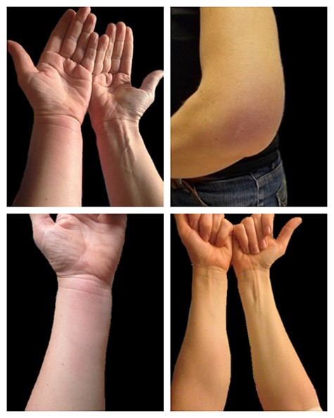 Four different episodes of localized erythematous swellings of the upper left limb.