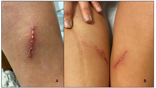 Pustulous ‘linear dermatitis’ on the left arm (A) with mirror lesions on medial region of both legs (B) due to Paederus spp.