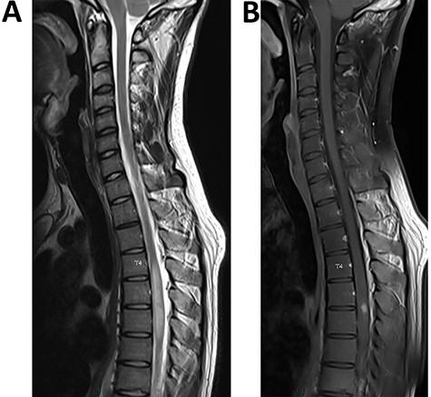 (A) (sagittal T2 sequence) Single long intramedullary lesion: spinal MRI showed swelling and diffuse T2 hyperintensity of the spinal cord from T4 to T7 levels. (B) (sagittal post-contrast T1 sequence) Nodular enhancement in the posterior region at the T5/T6 level