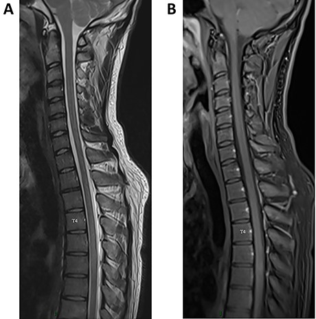 (A) (sagittal T2 sequence) Regression of the hyperintensity of the spinal cord. (B) (post-contrast T1sequence) Regression of the nodular enhancement