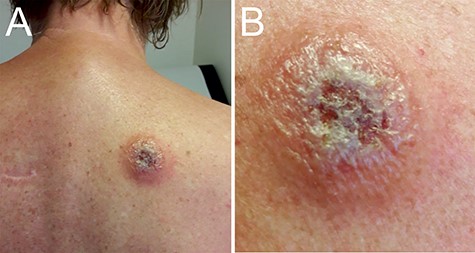 Trypanosomal chancre. Panel A shows the trypanosomal chancre on the back of the patient at presentation. The chancre had a diameter of ca. 5 cm with ulcerating and elevated edges. Panel B shows the swollen chancre at higher magnification.