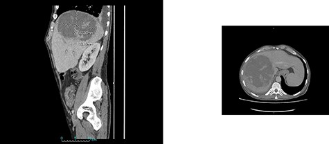 CT scan showing hepatic dome amebic liver abscess (10 × 14 cm).
