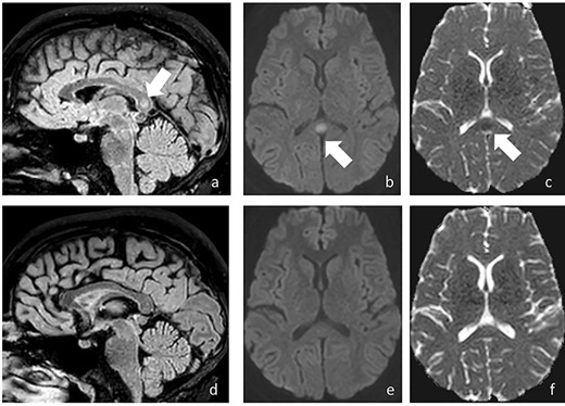 On sagittal FLAIR (a) a well-defined hyperintense lesion is detected in the splenium of the CLOCC; diffusion-weighted MR images (DWI) shows high signal on DWI (b) with corresponding low ADC (c), indicating diffusion restriction (arrow); the abnormality was consistent with cytotoxic lesion of the CLOCC; follow-up MRI 3 weeks later shows complete resolution of the abnormality (d–f)