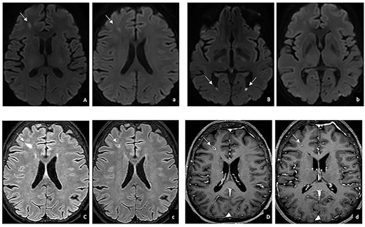 Brain MRI before (uppercase) and after (lowercase) antiparasitic treatment in DWI (A, B, a, b), T2-FLAIR weighted (C, c) and T1 weighted (D,d) images: reduction in DWI restriction (A,a), size (C,c) and contrast enhancement (D, d); resolution of the fluid levels in the lateral ventricles (B,b).