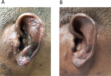 (A) Before treatment; (B) After treatment