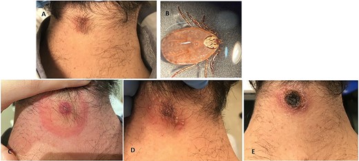 (A) Day 1 of symptoms: cutaneous lesion and right lateral cervical lymphadenopathy; (B) adult female Dermacentor marginatus removed from posterior neck area; (C) Day 2 of symptoms: erythema migrans-like lesion; (D) Day 5 of symptoms: neck eschar; (E) Day 12 of symptoms: necrotic eschar.