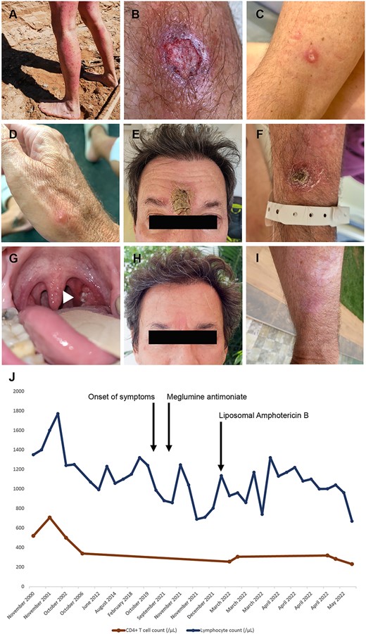 Clinico-biological presentation: (A) numerous local reactions to insect bites on the patient’s legs in Bolivia; (B–G) 15 lesions were distributed all over the body on the face, ear, upper and lower limbs in addition to an ulcerated lesion of the left tonsil; (B–D) papular and pustular and ulcerated skin lesion before treatment; (E and F) ulcerated skin lesions on initial presentation after failure of the first line of therapy; (G) ulcerated lesion of the right tonsil (arrow head); (H and I) healed lesions on the forehead (6 cm) after completion of the treatment with LAB; (J) evolution of total lymphocyte count (blue) and CD4+ T cell count (red) before and after completion of the treatment with LAB.