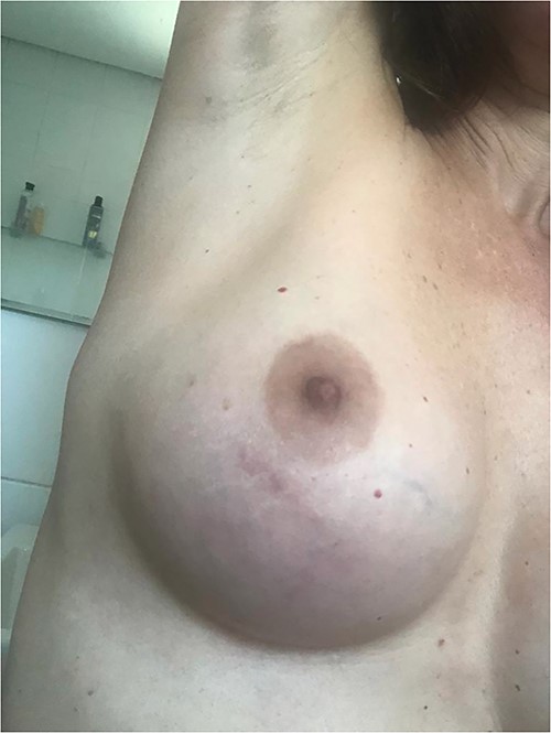 Erythematous-oedematous lesion with serpiginous linear path of migratory nature located on the right breast.