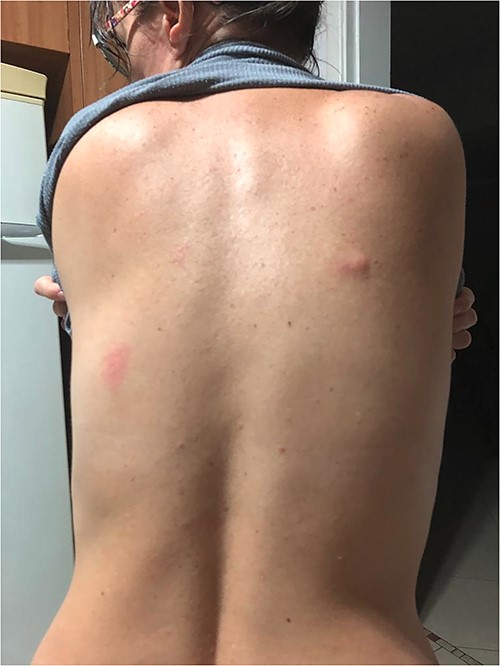 Erythematous-oedematous lesions with linear path located on the back.