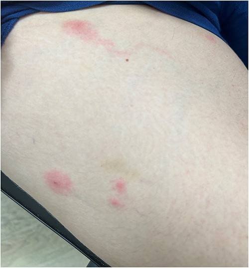 Lesions of the patient