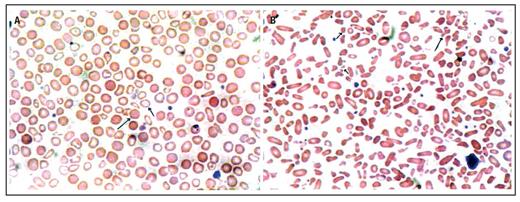 (A) Wright-stained peripheral blood film from post-iron treated patient ...