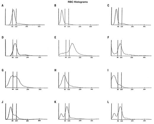 Red cell histograms in various hematological conditions. (Key ...