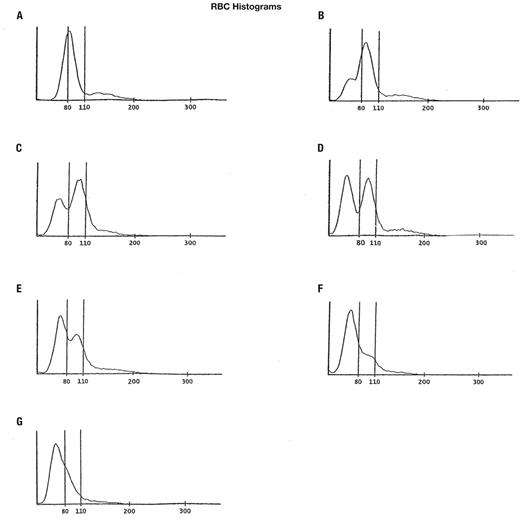 Histograms of iron deficiency anemia after treatment (key hematological ...