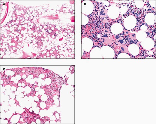 Essential Thrombocythemia and Post-Essential Thrombocythemia Myelofibrosis: Updates on Diagnosis, Clinical Aspects, and Management