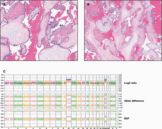 Histologic examination and chromosome microarray analyses of the product of conception (POC) sample. A and B, Histologic examination of the POC sample. H&E stain of the sample shows hydropic chorionic villi with syncytiotrophoblast hyperplasia (A) and dysmorphic villi with central cisterns (B). C, Whole genome view of chromosome microarray analysis. The result is a female with double trisomy 10 and 20, arr(10,20)x3, consistent with a karyotype of 48,XX,+10,+20. Chromosome microarray was performed using Affymetrix OncoScan microarray (Thermo Fisher Scientific).