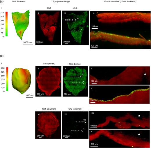 SI-MPM captures the detail of collagen and SMC actin across volume in thin samples Column 1 displays wall thickness maps for each specimen, created from 3D reconstructed micro-CT data. Remaining columns show data from large area MPM scans. (a) For aneurysm Case 2, the maximum wall thickness is 270 μm (i). The Z projection of Ch1 (ii) displays the heterogeneity in collagen signal intensity across the sample. The Z projection image of SMC actin (iii) shows heterogeneity in SMC actin density. Virtual XZ slices for stacked channels (10 μm thickness) are shown for regions of low (iv) and high (v) density SMC actin signal in Ch2. The SMC actin signal can be seen across the thickness in high-density region (v). (b) In contrast, aneurysm Case 4 is a thick sample (i) with regions that exceed the imaging depth of MPM and was therefore scanned from both luminal and abluminal sides. Z projections of both scans display detailed collagen fiber network (ii). In the orthogonal view seen in virtual XY slices (in iii: iv, v) and (in vii: viii, ix) the end of visible region from each imaging direction can be seen (arrows). Lumen is up in all images. Virtual slices from poor (iv) and rich (v) SMC actin regions show that SMC actin localized near the lumen surface in both regions.
