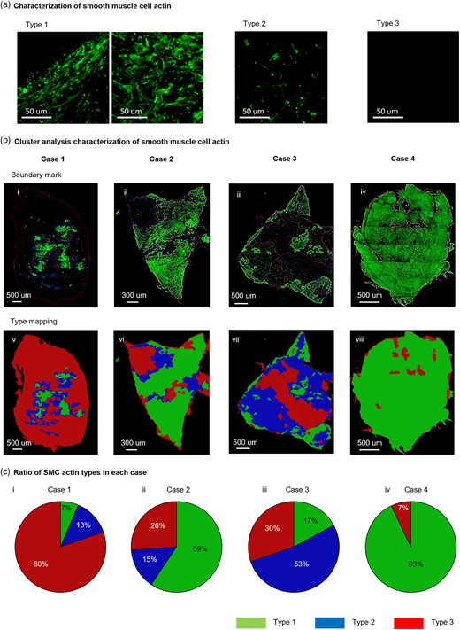 Demonstration of cluster analysis on SI-MPM images to objectively characterize regions of SMC actin density (a) Categories of wall region based on SMC actin density. Types 1, 2, and 3 correspond to high, moderate, and low density of SMC actin signal, respectively. (b) Cluster analysis was used to objectively identify regions of each SMC actin wall type in four cerebral aneurysm samples (Cases 1–4). In row 1 (i, ii, iii, iv), regions of each wall type are outlined in Z projections from Ch2. In row 2 (v, vi, vii, viii), the regions are filled with pseudo colors. (c) Post processing of cluster analysis results shown in (b) enable quantitative comparisons between samples, such as the ratio of area fraction of each SMC actin type for the four cases (ix, x, xi, xii).