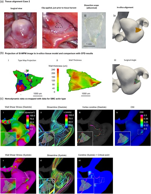 Comparison of hemodynamics and local wall biology of Case 2. Local comparison of SMC actin types and hemodynamic parameters. (a) A mapping procedure similar to that for Case 1 (Fig. 5) was used to determine the spatial relationship between the harvested specimen and the 3D reconstructed aneurysm. The dotted line in (ii) represents the location of the harvested tissue. (b) SMC actin wall type were mapped onto the lumen side of the 3D reconstructed specimen (i) and shown with a wall thickness map for comparison (ii). The sample predominantly featured Type 1 SMC actin, with a few locations of Types 2 and 3. Four regions (A, B, C, D) are denoted in i, with A and B being the left and right regions of Type 1 wall, respectively. C and D are two spatially distinct regions of Type 3 wall. The edges of Region D displayed high gradients of SMC actin and wall thickness (arrow). (c) The WSS in Region B was moderate to high approximately 50 dynes/cm2 during systole and below 20 dynes/cm2 during diastole. Regions A and C were both exposed to very high WSS of over 100 dynes/cm2 during systole (i, v). Additionally, Region B was exposed to high OSI (iv) while other regions had low OSI. A vortex core line existed behind the harvested region in both systole and diastole (iii, vii), but no critical point was observed at the site of the sample.