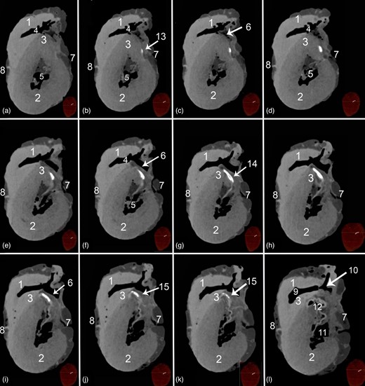 Transverse soft tissue window CT scans at the proximal parts of the ventricular mass of a heart containing Ossa cordis dextrum. 1. Right ventricular wall, 2. Left ventricular wall, 3. Interventricular septum, 4. Left ventricular cavity, 5. Right ventricular cavity, 6. Septal wall near to the right interventricular orifice, 7. Right longitudinal interventricular (sulcus interventricularis subsinuosus), 8. Left longitudinal interventricular groove (sulcus interventricularis paraconlais), 9. Conus arteriosus, 10. Tricuspid valve, 11. Bicuspid valve, 12. Aorta, 13. Cranial cross section of Ossa cordis dextrum (note its small oval shape), 14. Middle cross section of Ossa cordis dextrum (oval to rectangular shape), and 15. Caudal cross section of Ossa cordis dextrum (oval through to circular shape).