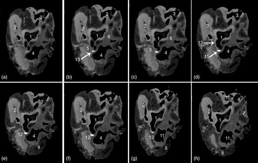 Transverse soft tissue window computed tomography scans within the base of the heart displaying the Ossa cordis sinistrum. (a–h) Scans taken at different points throughout the heart. 1. Aortic orifice (valve), 2. Pulmonary trunk valve, 3. Right atrioventricular orifice, 4. Left atrioventricular opening, 5. Left trigone, 6. Right trigone, 7. Right auricle, 8. Left auricle, 9. Caudal vena cava, 10. Cranial vena cava, 11. Pulmonary veins, 12. Ossa cordis sinistrum, and 13. Aortic wall.