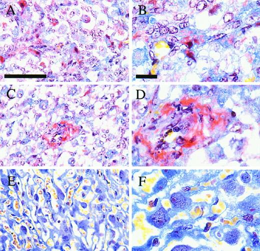 Histology of Mouse Placental Sections Stained with MSB to Reveal Fibrin Deposition Obtained from Mice Treated with VEGF (A, B, C, and D) or Vehicle (E and F) during Pregnancy Fibrin deposits are bright red, red blood cells are stained yellow, and other cells are stained blue. Scale bar, 50 μm in panels A, C, and E; 10 μm in panels B, D, and F.