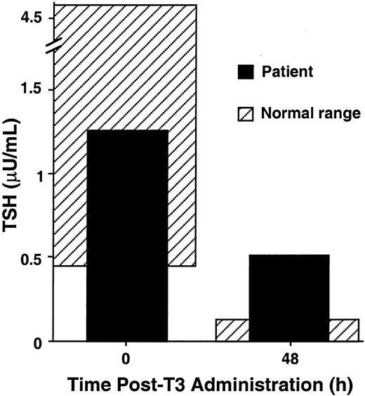 T3 Suppression Test of the Patient T3 (300 μg) was administered orally to the patient, and serum samples were obtained just before, and 48 h after, T3 administration for measurement of serum TSH. Normal basal serum TSH ranges from 0.43 to 4.60 μU/liter. Normal controls suppress to less than 10% of the baseline 48 h after T3 administration. Shaded areas represent normal ranges for baseline serum TSH and expected ranges for T3-suppressed serum TSH 48 h after T3 administration, respectively.