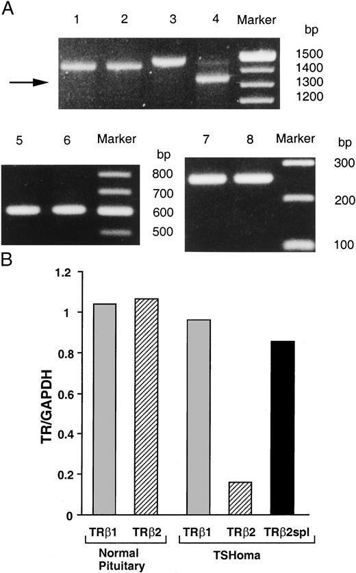 TRβ2spl Detection in a TSHoma A, RT-PCR was performed using mRNA from a TSHoma (lanes 2, 4, and 6) or pooled normal pituitary RNA from 87 individuals (lanes 1, 3, and 5). Primers were specific for the amplification of TRβ1 (lanes 1 and 2), TRβ2 (lanes 3 and 4), and GAPDH (lanes 5 and 6). Lanes 7 and 8 are products of exon 6 amplification of genomic DNA of TSHoma or circulating peripheral leukocytes of the same patient. B, Ratio of TR isoforms mRNA expression normalized with respect to GAPDH mRNA expression.