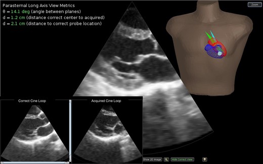 The transthoracic echo simulator interface. For feedback, the location and orientation of the plane of the image acquired by the trainee and the plane of the anatomically correct image are shown in the torso (blue and green sectors, respectively). The visual guidance display shows a 3D reconstruction of the heart of the patient in this study. The correct image is defined using anatomic landmarks carried from analysis of the original patient image data set to the final reconstruction. For example, the parasternal long axis view is defined from the centroid of the mitral annulus, the center of the aortic valve, and the left ventricular apex. The metrics of psychomotor skill are displayed at the upper left. For visual comparison of image quality, the correct and acquired images can be viewed side by side and played as cine loops (inset). During a test, the metrics and dual display are shown only after the trainee has completed the case and submitted his/her results.